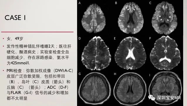 急性高氨血症脑病的影像表现