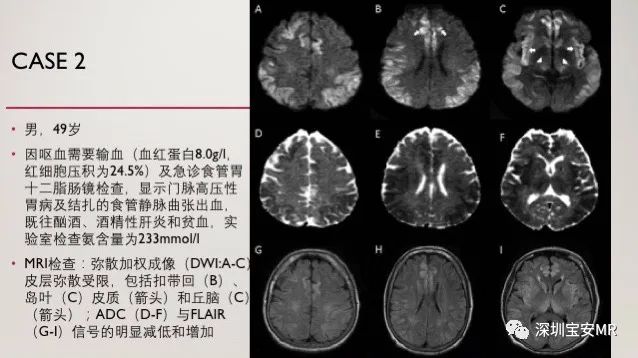 急性高氨血症脑病的影像表现-2 急性高氨血症脑病的影像表现-2