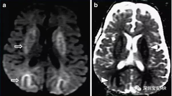 急性高氨血症脑病的影像表现-5 急性高氨血症脑病的影像表现-5