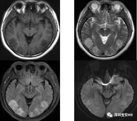 急性高氨血症脑病的影像表现-4