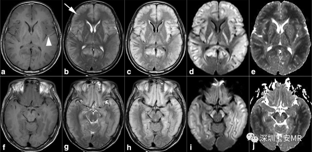 急性高氨血症脑病的影像表现-6