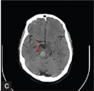 不同部位脑出血的表现-19 不同部位脑出血的表现-19