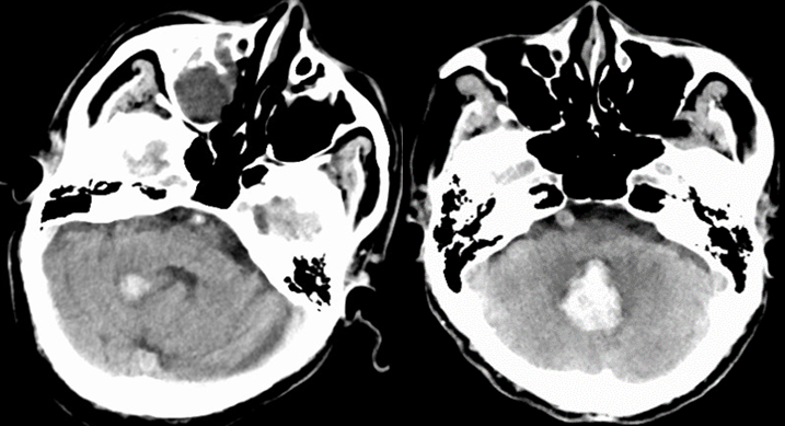 不同部位脑出血的表现-3 不同部位脑出血的表现-3