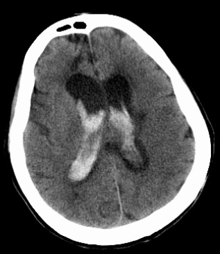 不同部位脑出血的表现-15 不同部位脑出血的表现-15