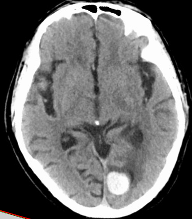 不同部位脑出血的表现-11 不同部位脑出血的表现-11
