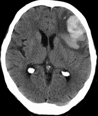 不同部位脑出血的表现-9 不同部位脑出血的表现-9