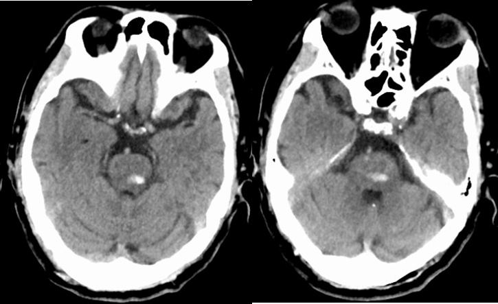 不同部位脑出血的表现-17 不同部位脑出血的表现-17