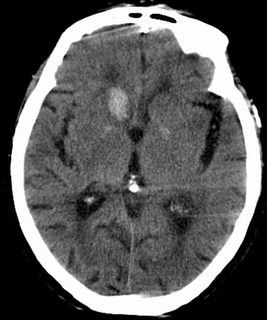 不同部位脑出血的表现-1 不同部位脑出血的表现-1