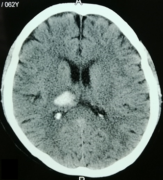 不同部位脑出血的表现-5 不同部位脑出血的表现-5