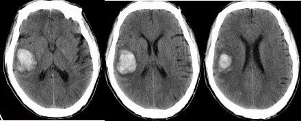 不同部位脑出血的表现-7 不同部位脑出血的表现-7