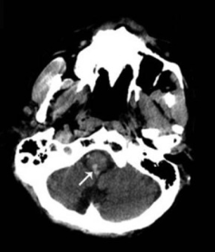 不同部位脑出血的表现-21 不同部位脑出血的表现-21