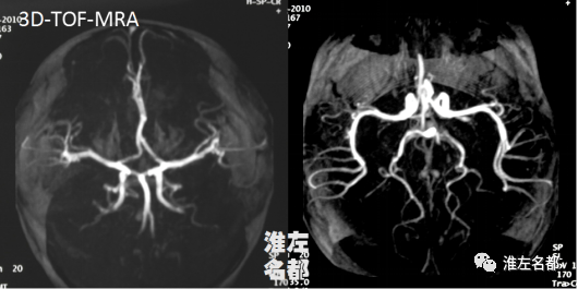 【病例】婴儿外伤后基底节梗死1例CT及MR-4
