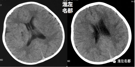 婴儿外伤后基底节梗死1例CT及MR