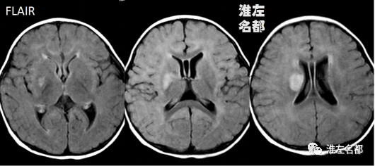 【病例】婴儿外伤后基底节梗死1例CT及MR-3