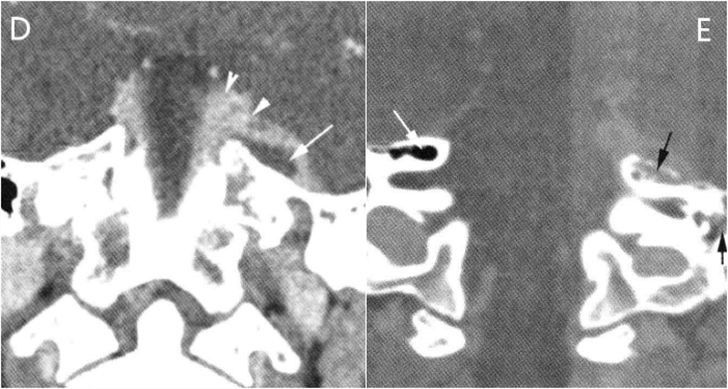 【病例】岩尖炎伴硬膜外脓肿1例CT影像-2 【病例】岩尖炎伴硬膜外脓肿1例CT影像-2