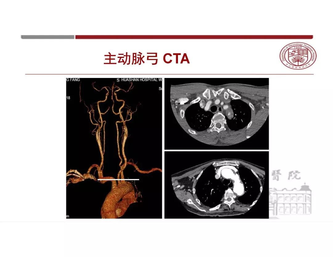 【PPT】脑血管的解剖基础-5