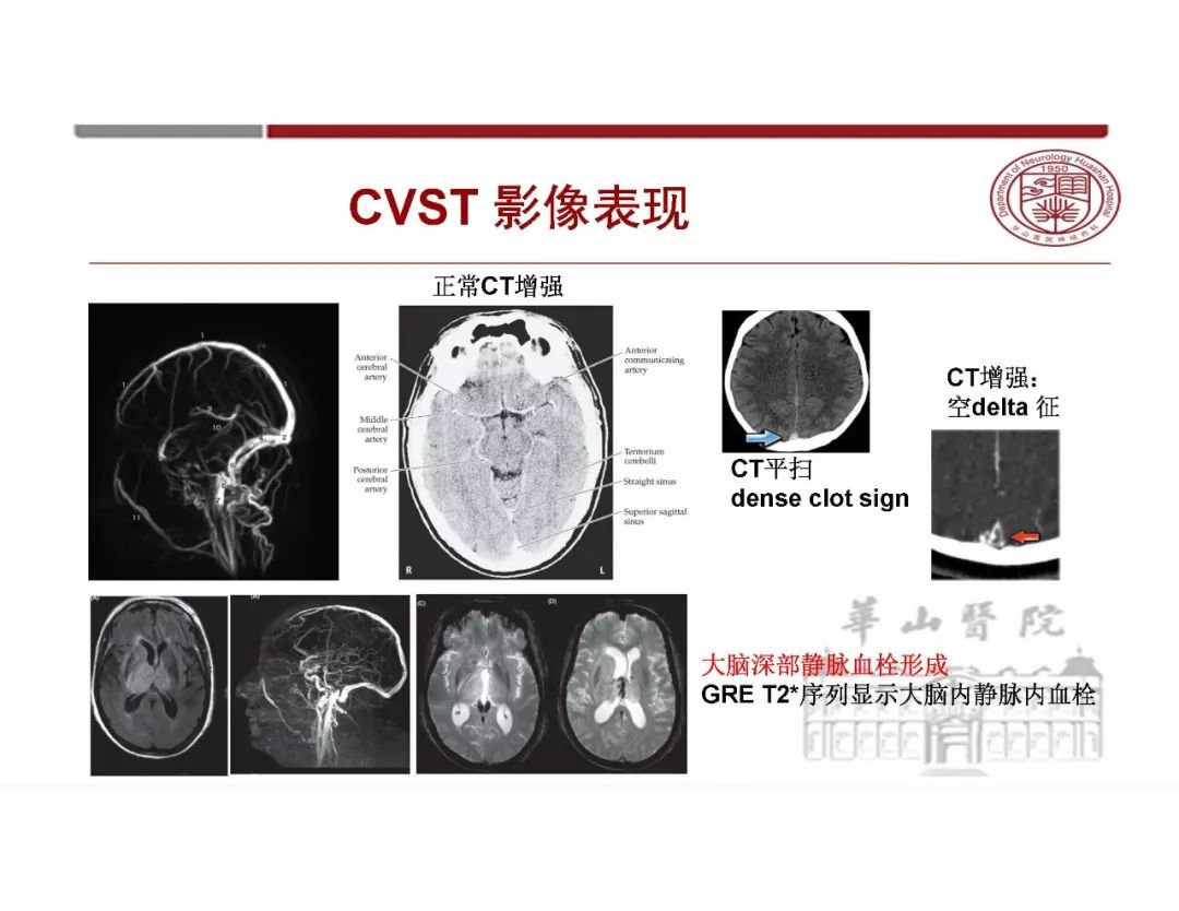 【PPT】脑血管的解剖基础-44
