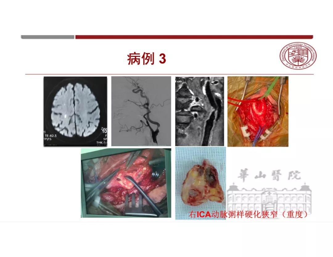 【PPT】脑血管的解剖基础-11