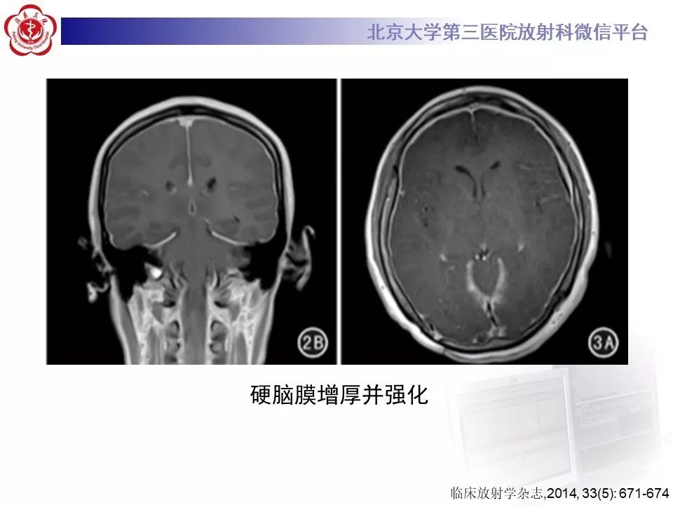 【PPT】低颅压综合征的MR影像