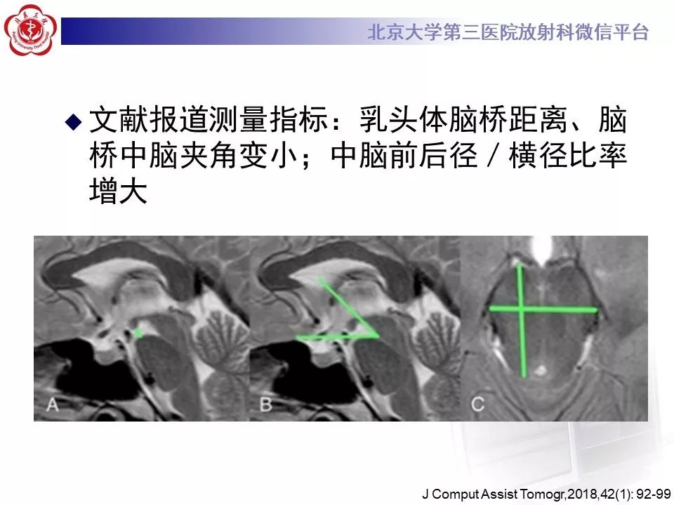 【PPT】低颅压综合征的MR影像