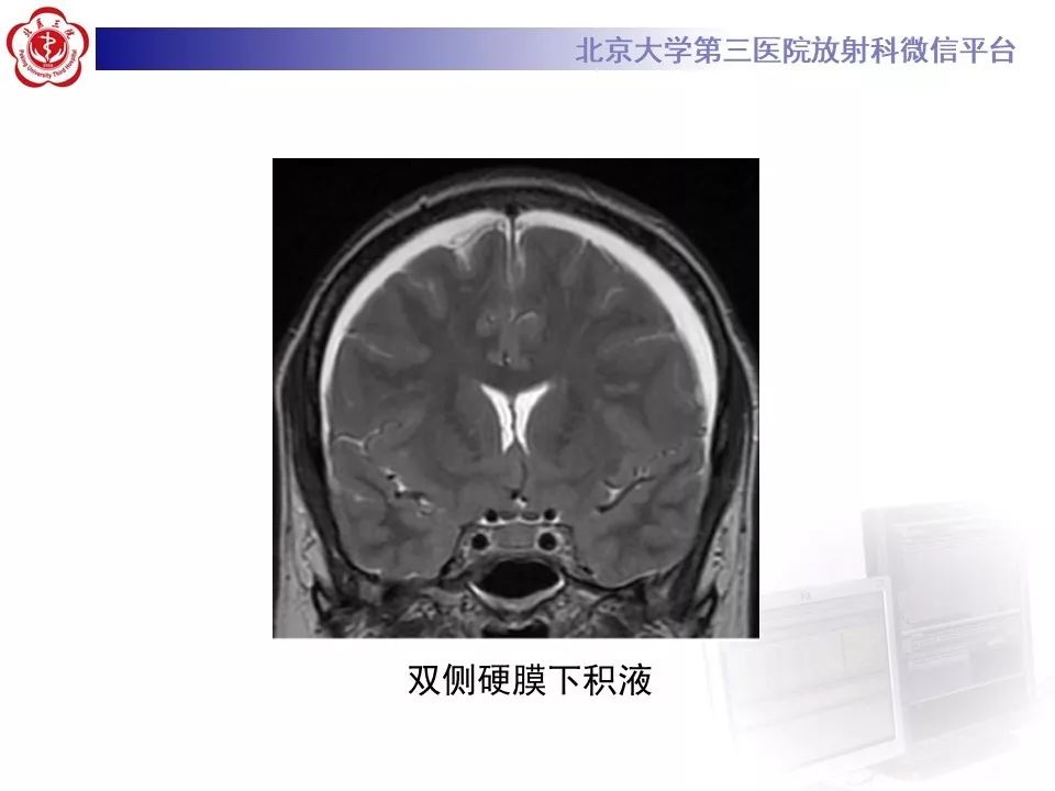 【PPT】低颅压综合征的MR影像