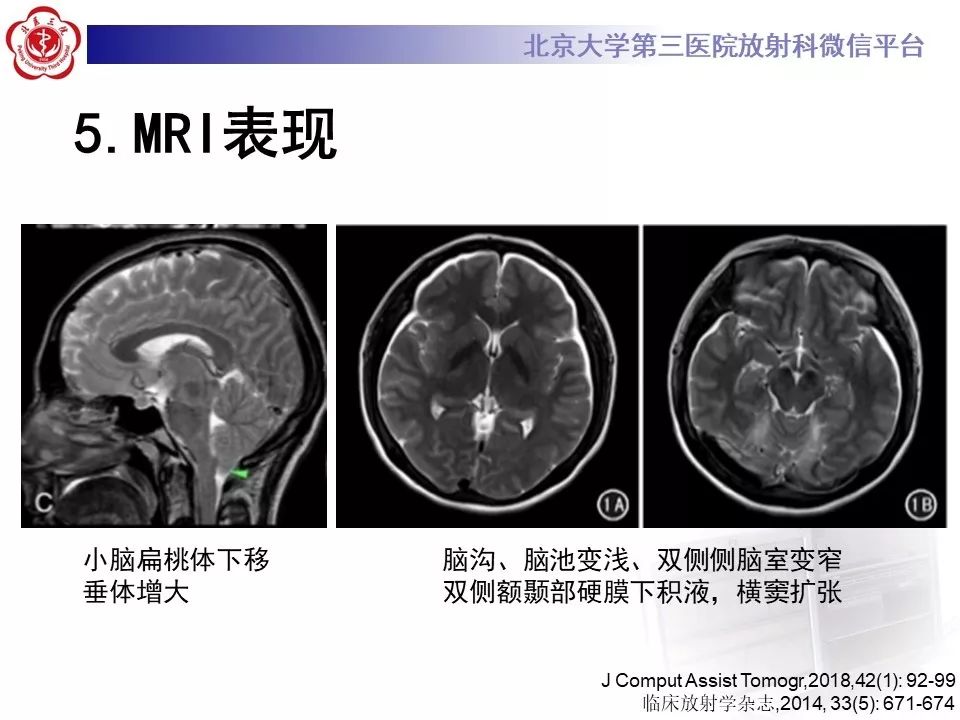 【PPT】低颅压综合征的MR影像