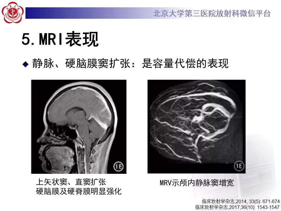【PPT】低颅压综合征的MR影像