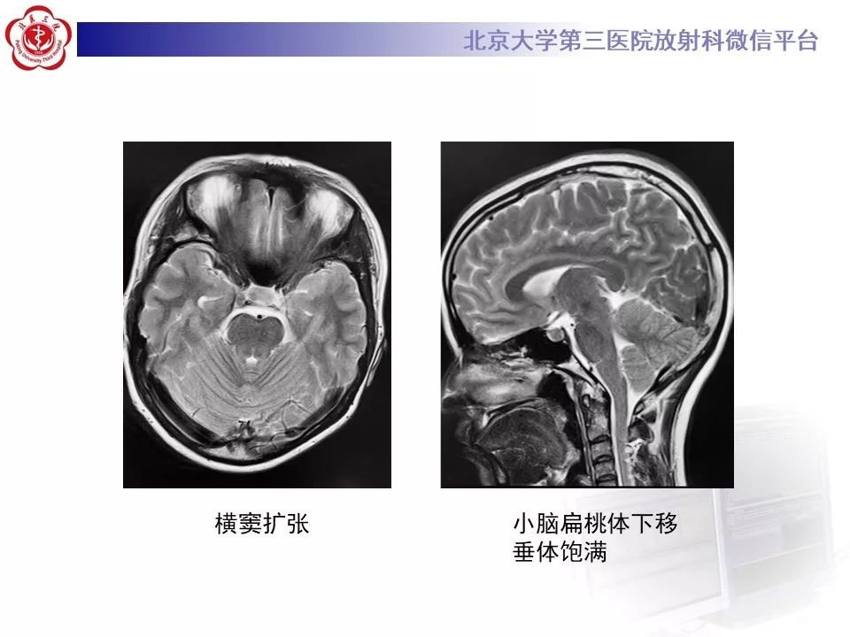 【PPT】低颅压综合征的MR影像