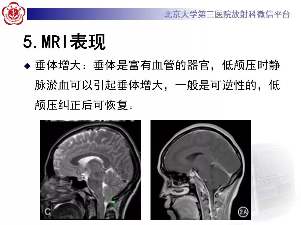 【PPT】低颅压综合征的MR影像