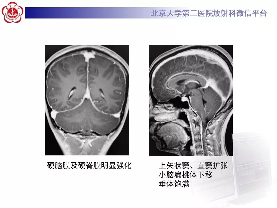 【PPT】低颅压综合征的MR影像