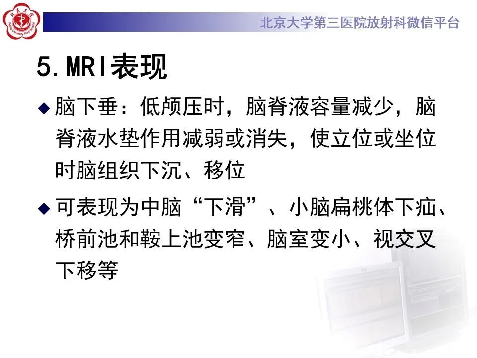 【PPT】低颅压综合征的MR影像