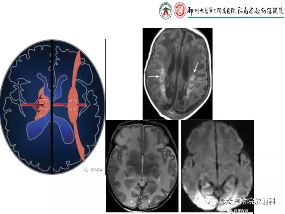 【PPT】常见弥漫性脑皮层病变