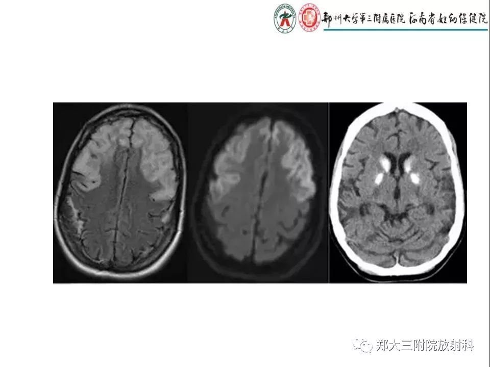【PPT】常见弥漫性脑皮层病变