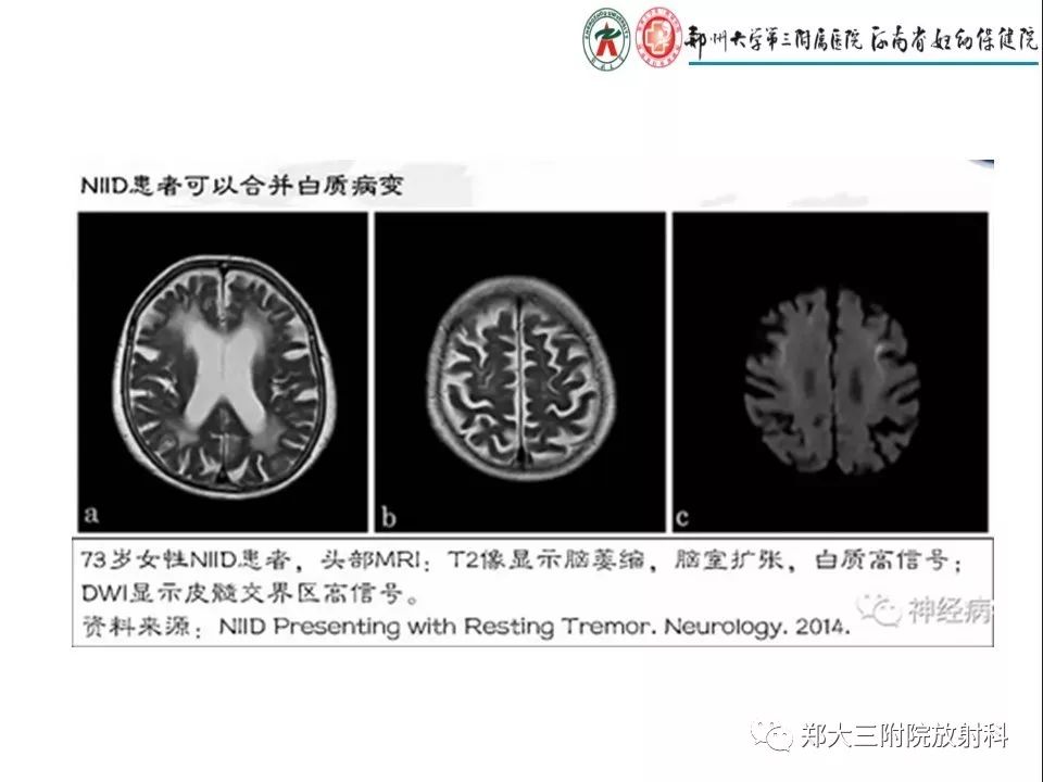 【PPT】常见弥漫性脑皮层病变
