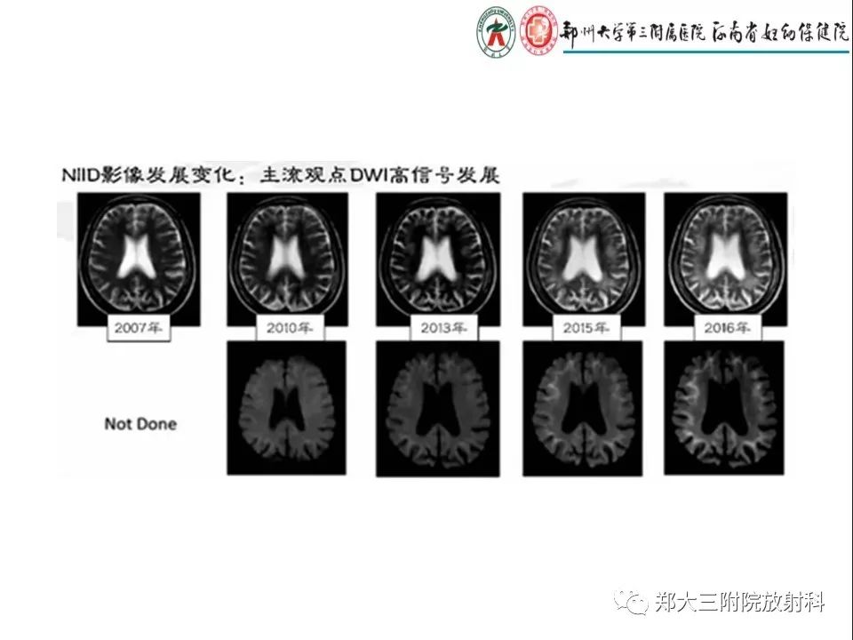 【PPT】常见弥漫性脑皮层病变