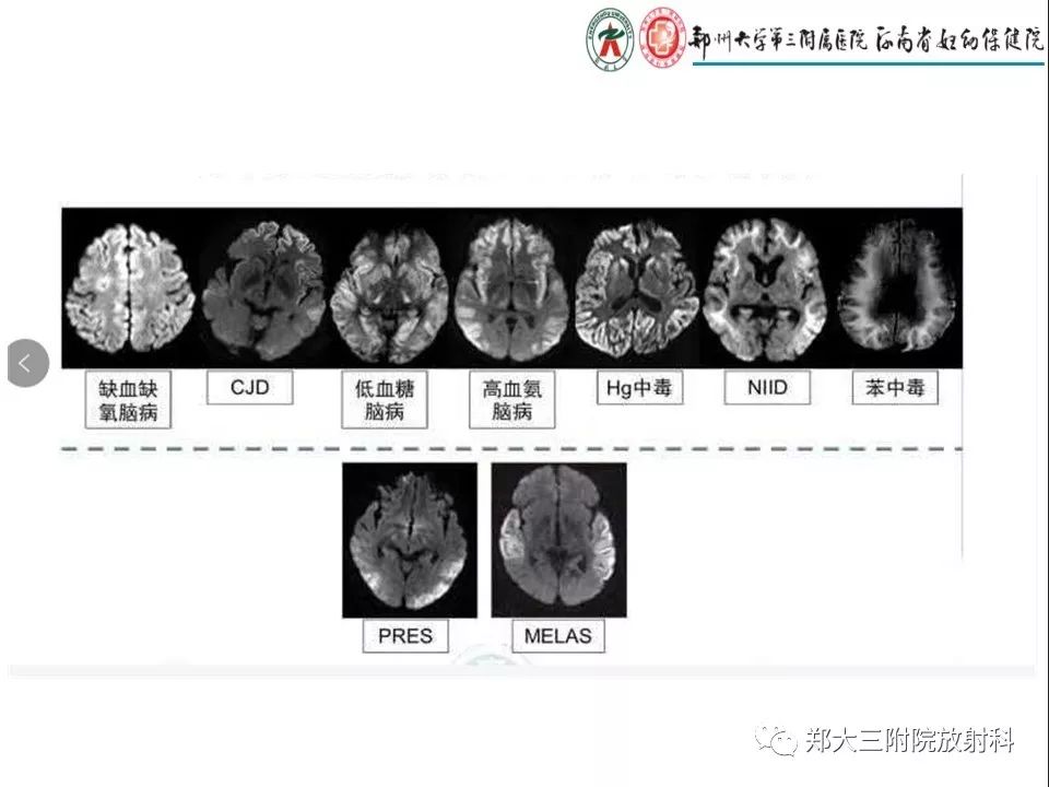【PPT】常见弥漫性脑皮层病变