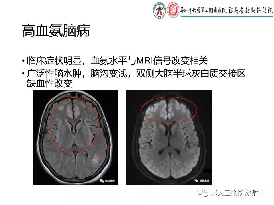 【PPT】常见弥漫性脑皮层病变
