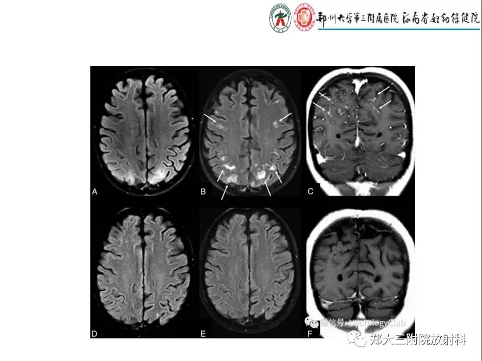 【PPT】常见弥漫性脑皮层病变