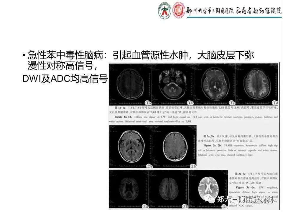 【PPT】常见弥漫性脑皮层病变