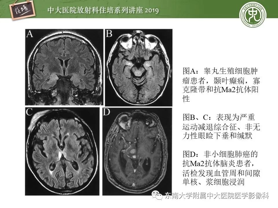 【PPT】自身免疫性脑炎影像表现及诊断