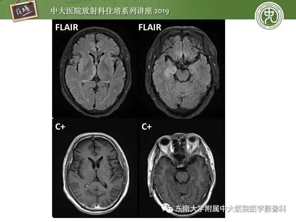 【PPT】自身免疫性脑炎影像表现及诊断