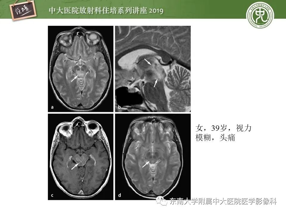 【PPT】自身免疫性脑炎影像表现及诊断