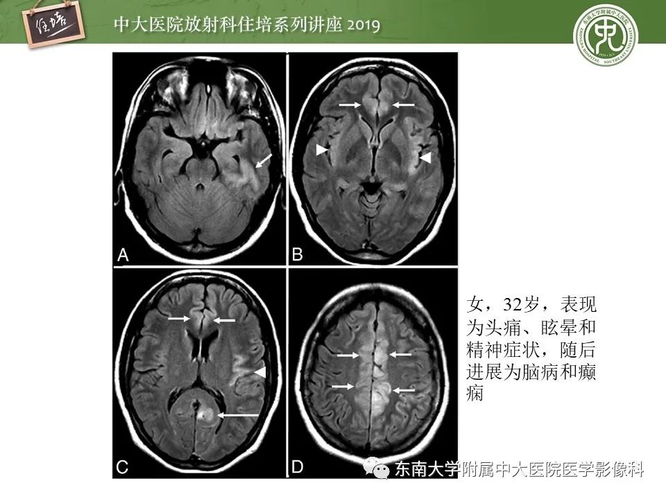 【PPT】自身免疫性脑炎影像表现及诊断