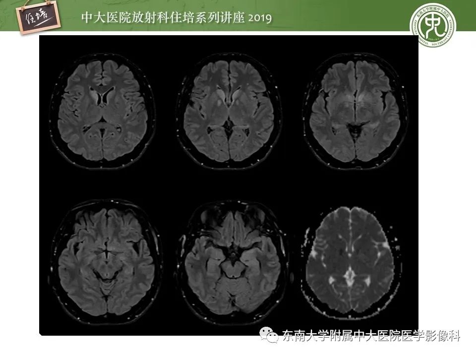【PPT】自身免疫性脑炎影像表现及诊断