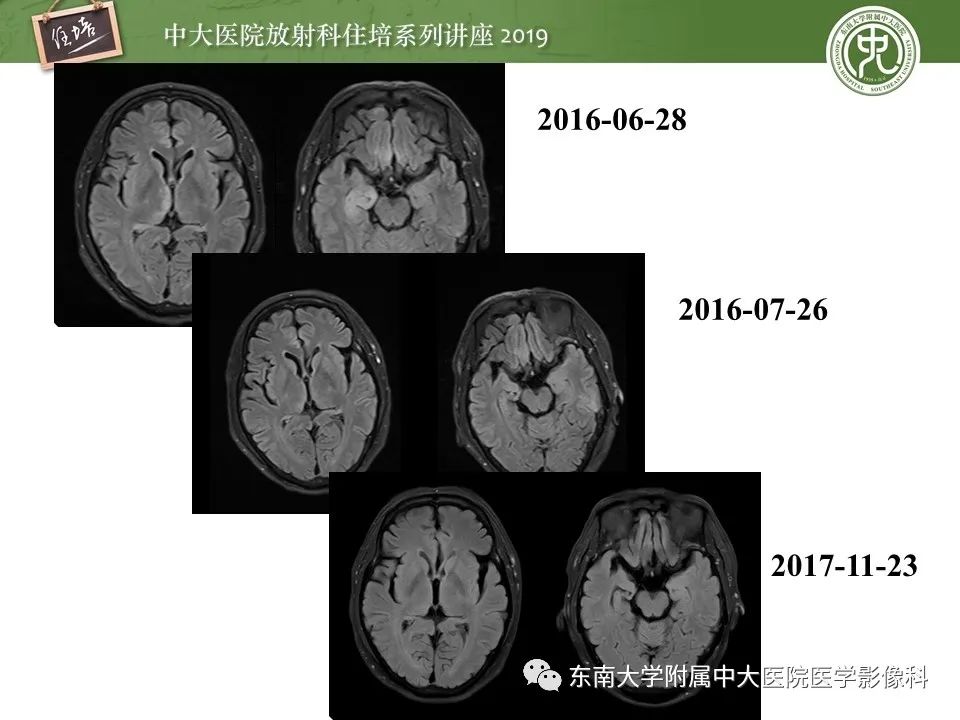 【PPT】自身免疫性脑炎影像表现及诊断
