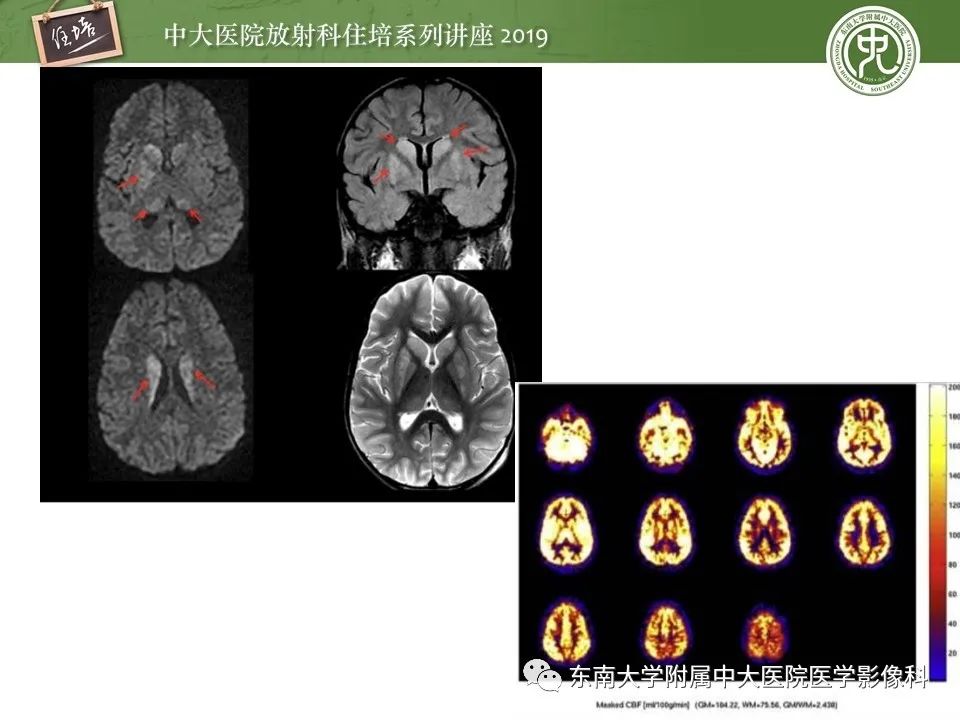 【PPT】自身免疫性脑炎影像表现及诊断
