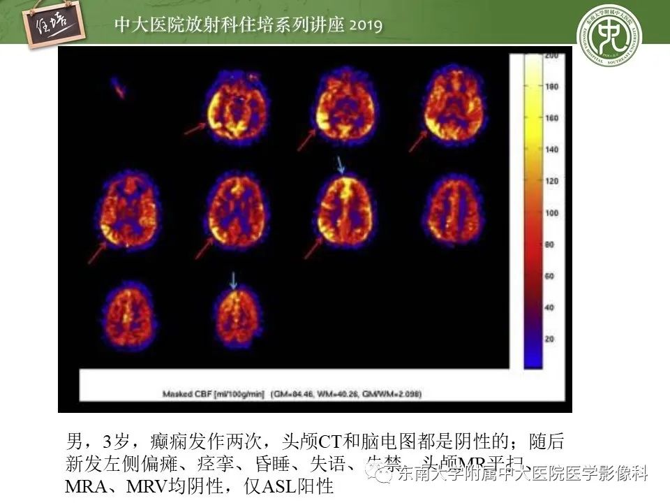 【PPT】自身免疫性脑炎影像表现及诊断