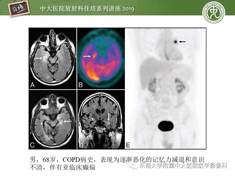 【PPT】自身免疫性脑炎影像表现及诊断