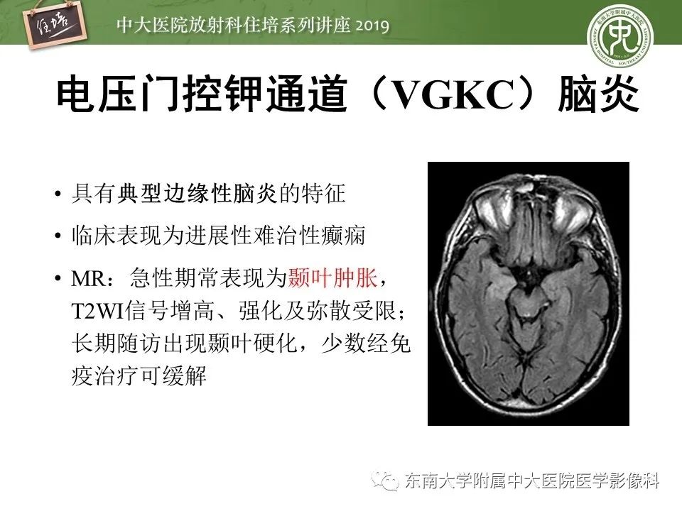 【PPT】自身免疫性脑炎影像表现及诊断