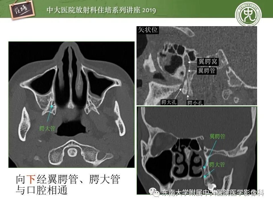 【PPT】翼腭窝的影像解剖及临床意义